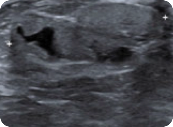 breast tissue under ultrasound